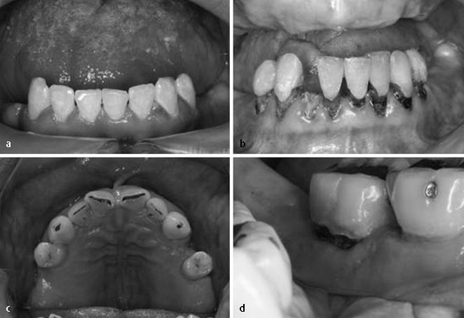 deficiente Curva de ph do biofilme dental após bochecho com glicose