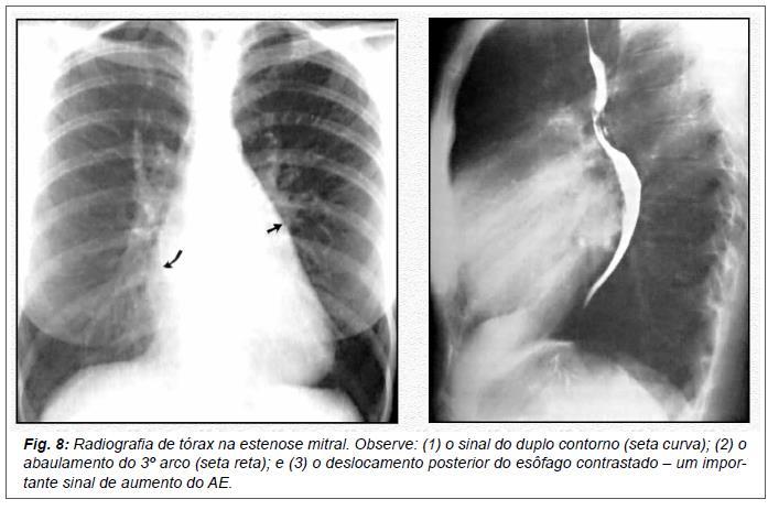 o Endocardite infecciosa: fluxo turbulento formação de trombos que aderem à valva abrigo para bactérias bacteremia infecção sistêmica destruição valvar pela endocardite insuficiência valvar Exames