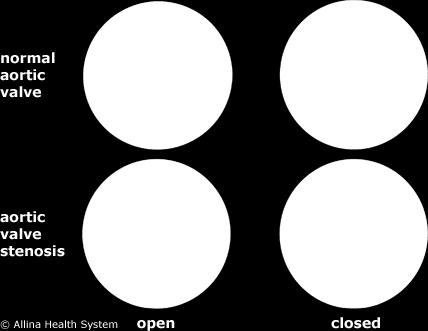 os espaços logo acima das cúspides, denominados seios de Valsalva, de onde se originam as duas artérias