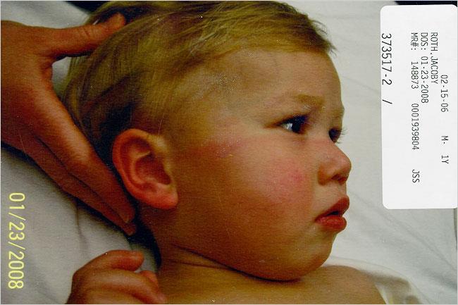 Criança submetida a TC seios da face repetidas vezes: Radiodermite aguda