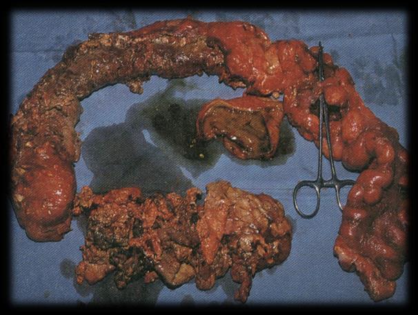 Complicações da Pancreatite Aguda