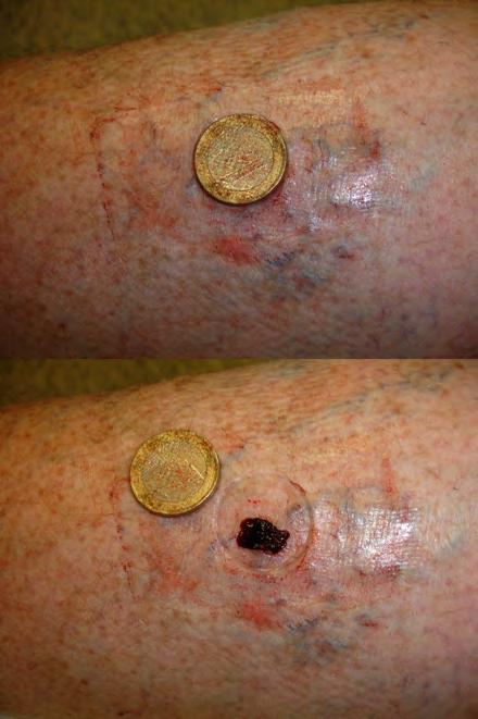 Cauze și metode de tratare a petelor pe picioare cu varice - Articole - August