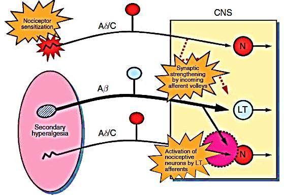 Hiperalgesia secundária Primary hyperalgesia is produced by the stimulation of nociceptors connected to A - and C-afferent fibers which activate nociceptive CNS pathways (N).