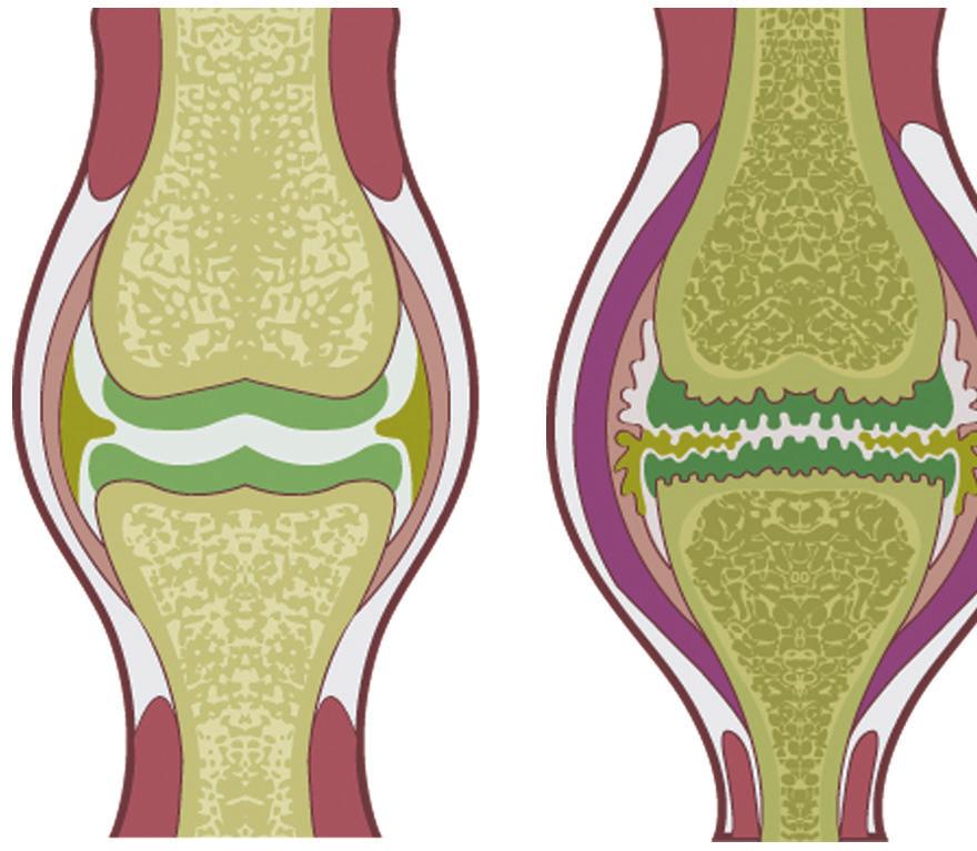 1. Osteoartrite conceitos atuais A osteoartrite (OA) é a forma mais comum de artrite e clinicamente uma causa significativa de incapacidade.
