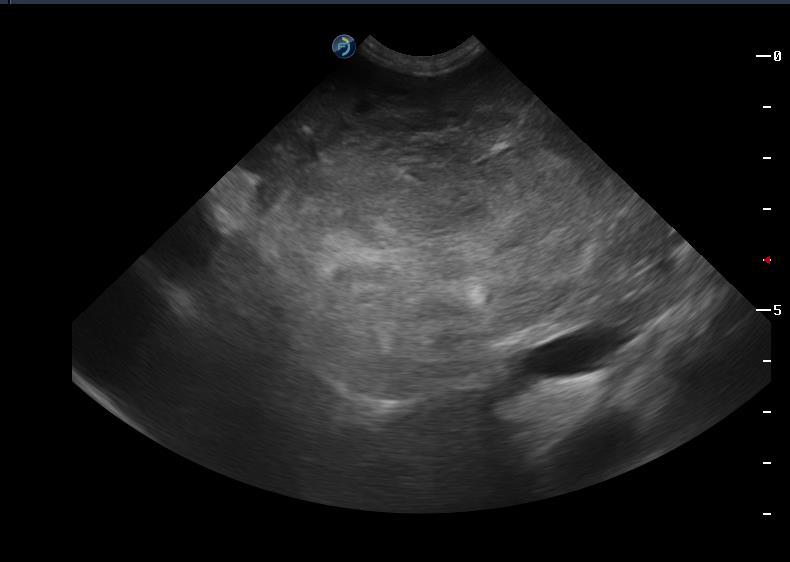 25 A conclusão diagnóstica foi hepatomegalia com massa de aspecto neoplásico em topografia de lobos esquerdos com evidente atividade ao color Doppler.