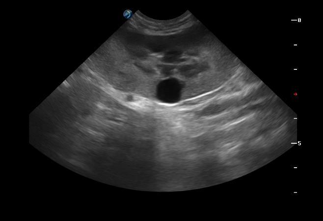 27 A B Figura 7: Imagem ultrassonográfica de rim esquerdo e direito respectivamente, evidenciando uma glomerolunefropatia cística bilateral, área cística.