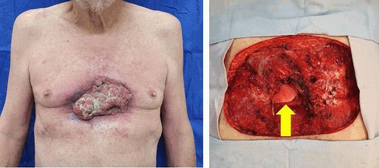 1039 Homem, 67 anos, sem comorbidades, possui diagnóstico de carcinoma espinocelular (figura esquerda). A tomografia de tórax identificou acometimento de arcos costais a direita.