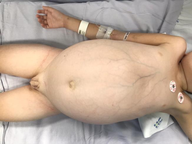 1042 Menino, 6 anos, em pós operatório de abaixamento de cólon endoanal por doença de Hirschsprung.