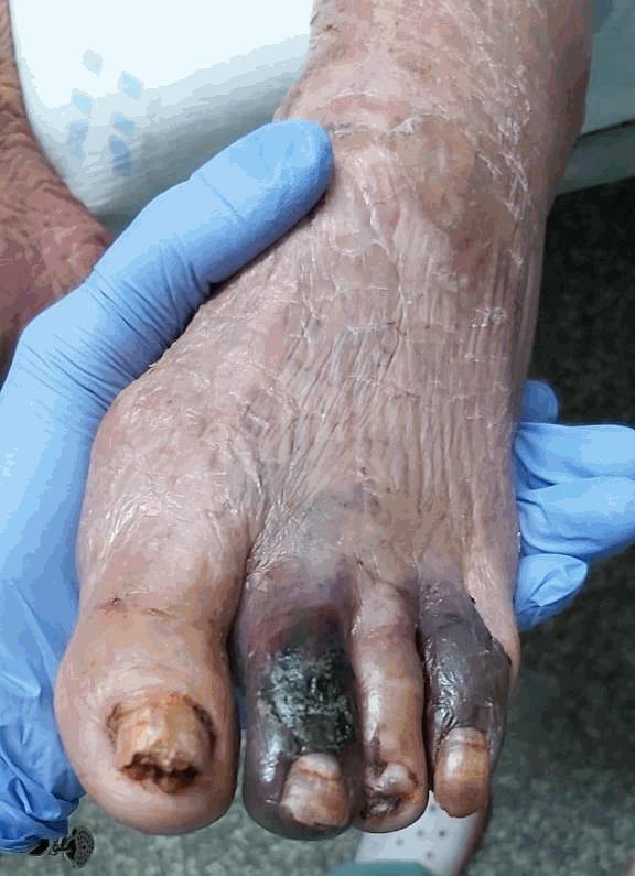 1043 Homem, 71 anos, diabético com dor em pé esquerdo associado a escurecimento de segundo e quarto artelhos (Figura em anexo).