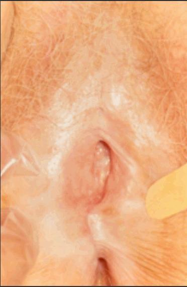 1050 Mulher de 63 anos, com menopausa há 14 anos, G2P2A0C0, procura serviço médico com queixa de prurido vulvar. O achado do exame físico está apresentado abaixo.