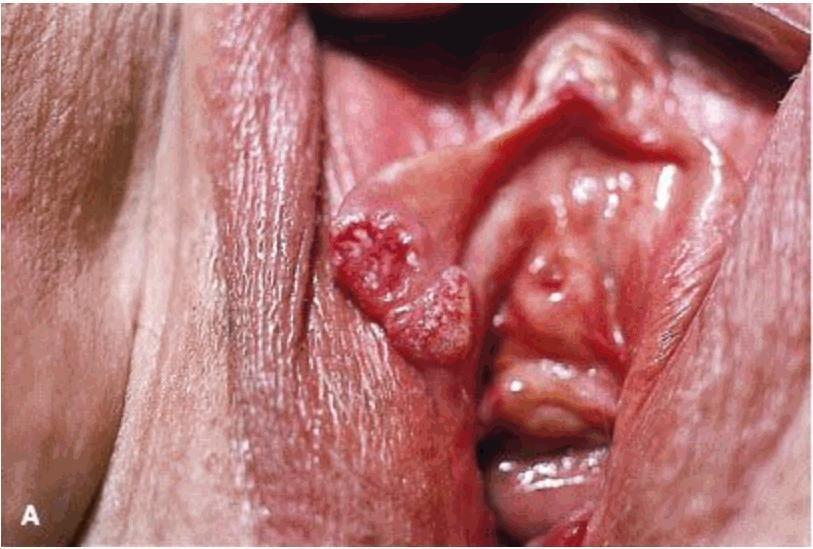 1058 Mulher de 75 anos queixa de prurido na região vulvar há seis meses. Nega atividade sexual há 15 anos. O exame ginecológico está representado na figura.