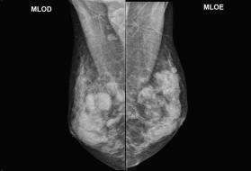 Realizada mamografia e ultrassonografia de mamas e axilas conforme imagens a seguir: MAMOGRAFIA BILATERAL CC MAMOGRAFIA BILATERAL MLO