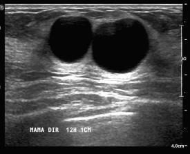 substituída pela ultrassonografia mamária. B - Deve ser realizado esvaziamento dos cistos mamários independentemente da sintomatologia.