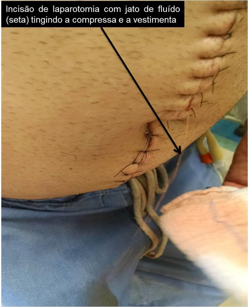 1015 Homem de 26 anos, previamente hígido, vítima de trauma abdominal fechado, foi admitido em choque hipovolêmico e tratado mediante laparotomia mediana com esplenectomia, enterorrafia de lesão