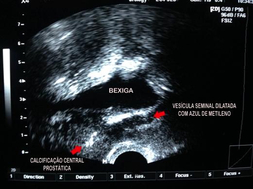 vesical Bexiga Hiperativa e Prolapso Vesical: Como Conduzir?