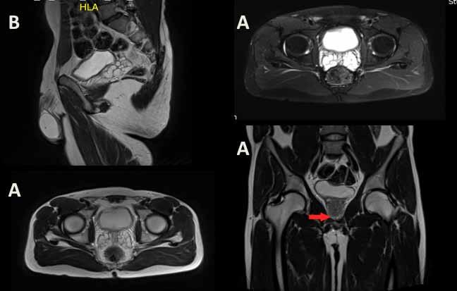 Azoospermia por obstrução de ducto ejaculador por cálculos como causa de infertilidade primária: diagnóstico e tratamento Figura 1 Ressonância magnética de pelve com sequencias ponderadas em t1 e t2