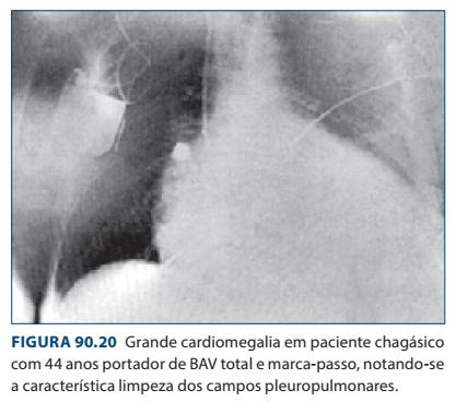 o Bradiarritmias à reflete bloqueio atrioventricular avançado, levando a síncopes graves em virtude do baixo débito.