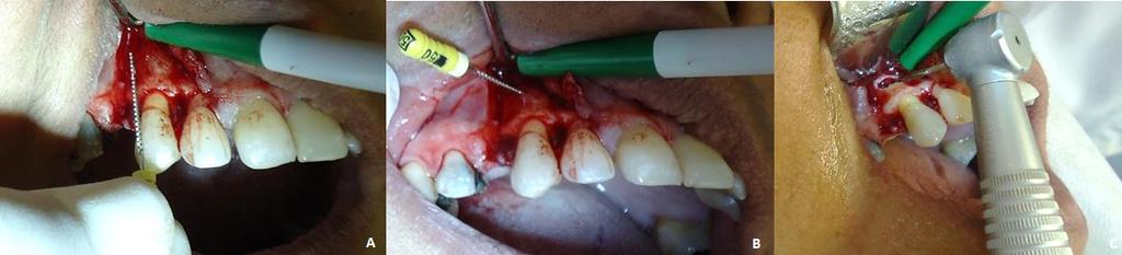 Figura 3A, B e C Foto da localização da lesão e confecção da loja cirúrgica. A: Localização da lesão periapical provocada pela periodontite apical crônica, com auxílio de uma Lima k nº 50.