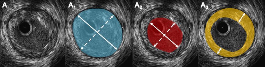 45 3.2.2.1. Seleção do Diâmetro dos Stents por USIC Medidas básicas do vaso coronário pelo USIC pré-implante de stent são apresentadas na Figura 9.