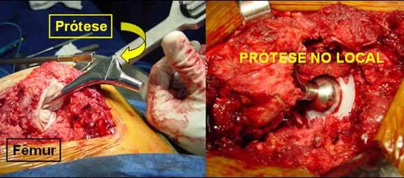 7 Fig. 03 Prótese Total de Quadril Fonte: http://drmarkdeeke.com.br/faq.aspx?