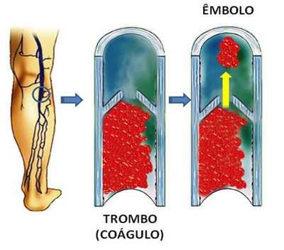 9 Fig. 04 ATrombose Venosa Profunda Fonte: http://www.sbquadril.org.br/info-pacientes.php?