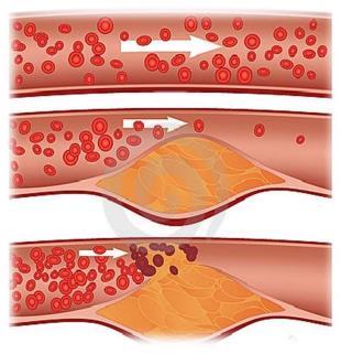 Aterosclerose Doença crônica que afeta a parede das artérias (de médio e grosso calibres), levando a formação de placas de gordura (ateromas) que podem comprometer o fluxo
