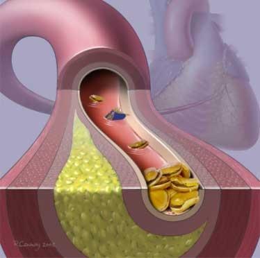 Consequências O bloqueio de uma artéria que leva sangue ao coração pode causar um infarto do miocárdio, o bloqueio de uma artéria que leva sangue ao cérebro pode levar a um