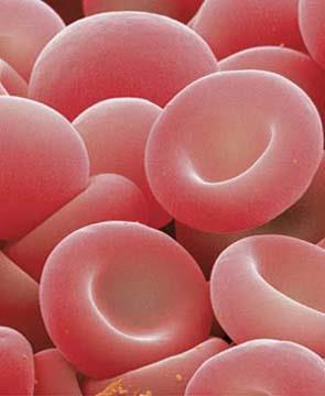 Anemia falciforme Doença Falciforme: hemoglobina S~ em concentração> 50%. A Hemácia falcisada vive metade do tempo que um eritrócito normal vive.