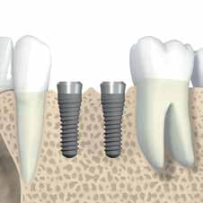 3.1.1 Posição mesiodistal dos implantes A disponibilidade mesiodistal do osso é um factor importante para a selecção do tipo e do diâmetro do implante.