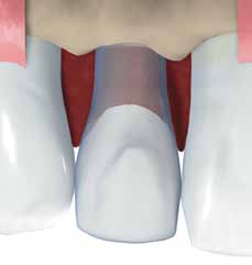 3.1.1.1 Exemplos para espaços entre dentes individuais Para a restauração de um dente individual o implante é inserido no espaço do dente individual numa posição central.