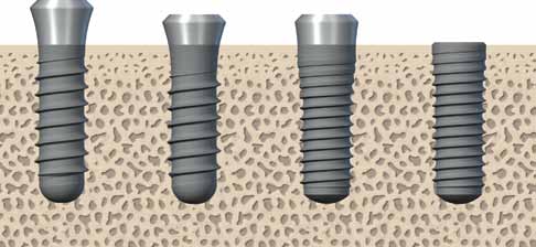 3.1.3 Posição corono-apical do implante Os implantes dentários Straumann permitem uma posição corono-apical flexível do implante, em função da anatomia individual, do local de implantação, do tipo de