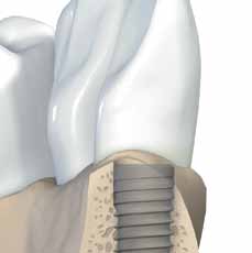 Implantes Straumann Bone Level Os implantes Straumann Bone Level são posicionados, de preferência, de forma que o bordo exterior do pequeno canto com um chanfro de 45º (fase) se situa ao nível do