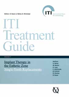 Para mais informações sobre os procedimentos cirúrgicos em casos esteticamente exigentes consulte as seguintes publicações científicas: ITI Consensus Paper ITI Treatment Guide Buser D./ Martin W.