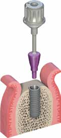 4.4.2 Cicatrização transmucosal Uma vasta gama versátil de tampas de cicatrização e pilares de cicatrização está à sua disposição para todos os implantes Straumann, permitindo a modelagem do tecido