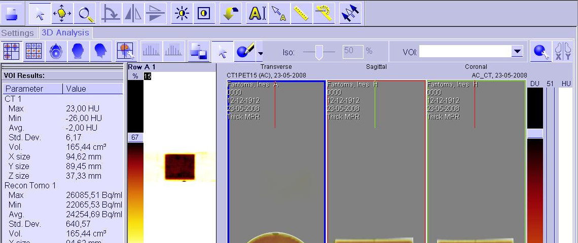 5.4 Análise de dados Seguidamente à reconstrução das imagens, estas foram transferidas para uma estação de trabalho onde foram visualizadas e analisadas. 5.4.1.