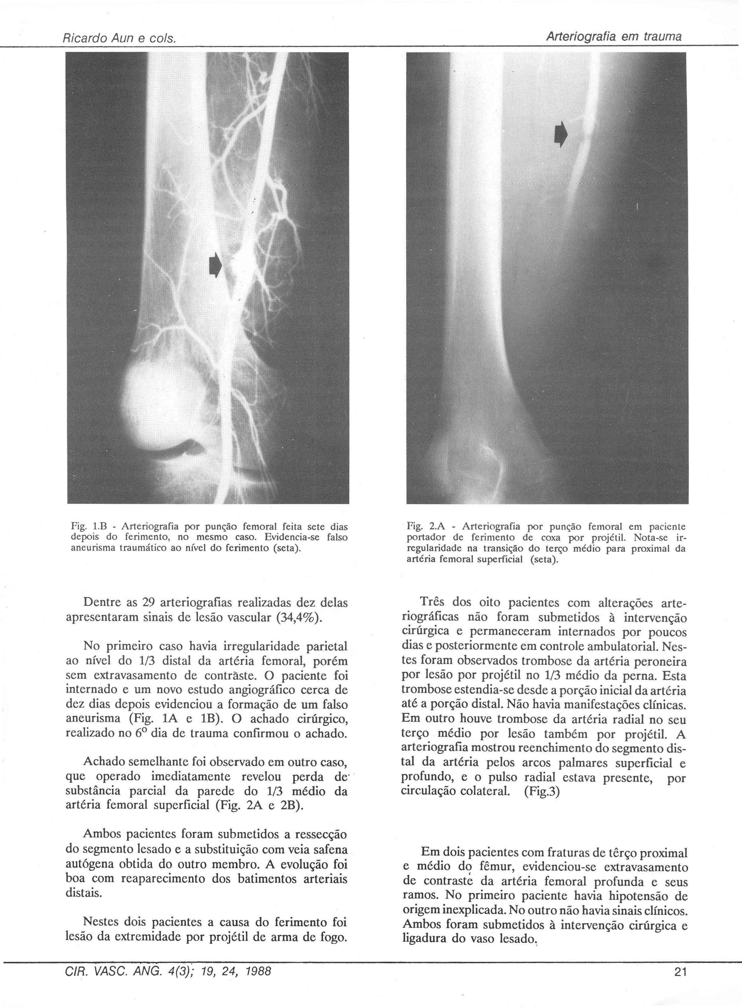 Ricardo Aun e co/s. Arteríografia em trauma Fig. l.b - Arteriografia por punção femoral feita sete dias depois do ferimento, no mesmo caso.