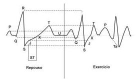 amplitude, quando analisada em CM5 ao final da fase de exercício; onda R - analisada preferencialmente em CM5, tem ampla gama de variações diminuindo, em geral, em níveis máximos de FC e no período