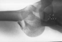 5 Radiografia axilar, ombro direito, mostrando uma fratura-luxação posterior permanente (posição 5) Fig.