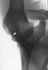 7 Radiografia apical-oblíqua, ombro direito, mostrando em um paciente de luxação recidivante anterior o defeito póstero-lateral da cabeça do úmero