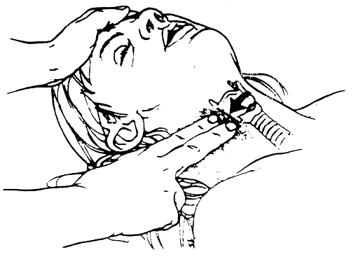 Quando a pulsação radial está muito fraca, a verificação do pulso pode ser feita com mais facilidade na região do pescoço (artérias carótidas).