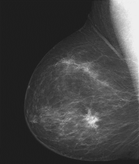 A mamografia permite visualizar a região