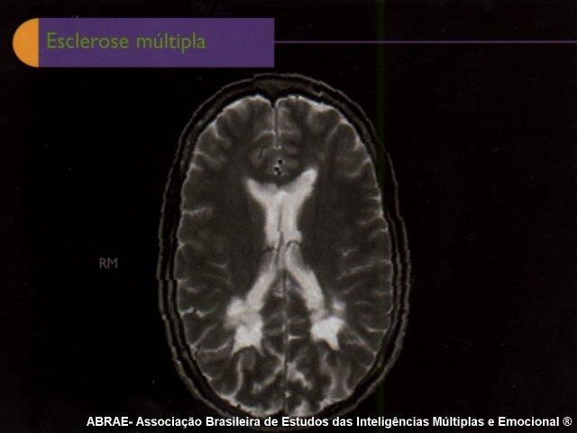 Esclerose múltipla:auto-imune. Destruição da bainha de mielina.