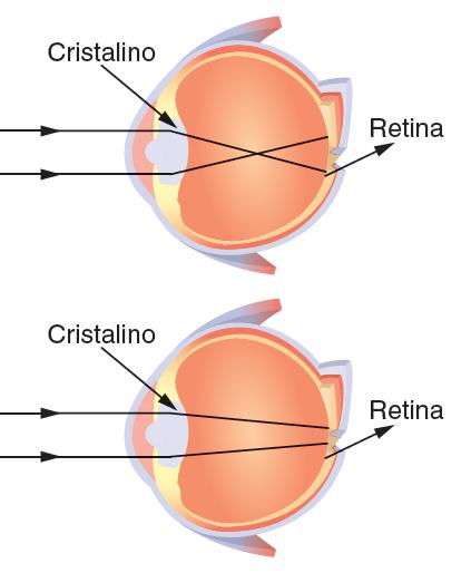 Exercício 2 SILVIA Imagem se forma ANTES da retina. Olho muito convergente. Correção: lente divergente.