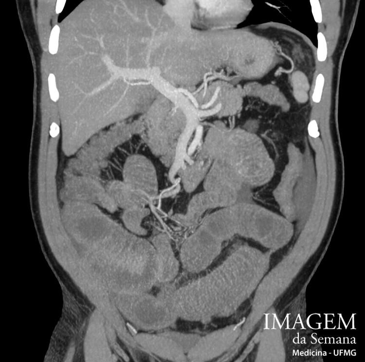 Imagem da Semana: Radiografia e tomografia computadorizada (TC) Figura 1: Radiografia de abdome em incidência