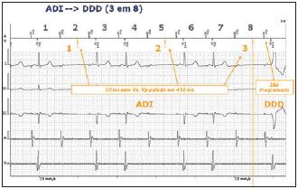 Vp suppression - Biotronik ADI DDD Notas: 2 segundos de ausência de evento ventricular intrínsecos 3 ciclos em 8 sem evento ventricular intrínsecos A primeira estimulação ventricular após o