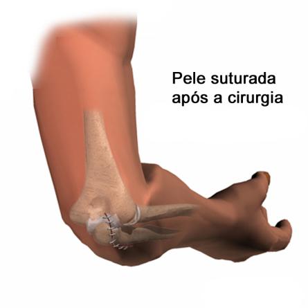 Uma vez que a bursa é um componente extra articular, não se deve entrar na articulação. A bursa é removido e a pele fechada com pontos.