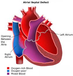 CIA Comunicação Interatrial Lesão que ocorre entre os átrios D e E. Consiste na presença de um orifício no septo interatrial.