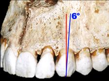 Anatomia Dental Interna Caninos Superiores Canino