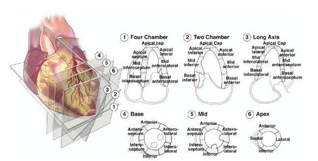 Anexo 4 Medições da cavidade do VD em plano apical 4C. Fonte: Rudski, L. G., Lai, W. W., Afilalo, J., Hua, L., Handschumacher, M. D., Chandrasekaran, K., Schiller, N. B. (2010).