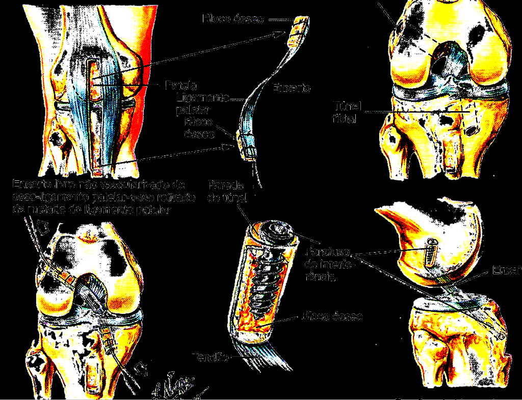 Reconstrução Ligamentar - LCA Tendão Patelar AMB 92 52.13.